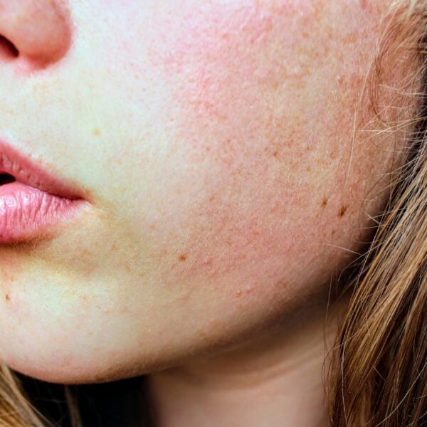 Genetic Variants May Link to Rosacea