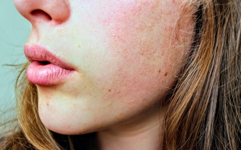 Genetic Variants May Link to Rosacea