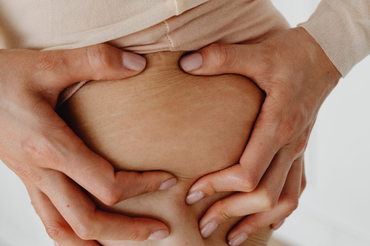 Genetic Predisposition for Stretch Marks