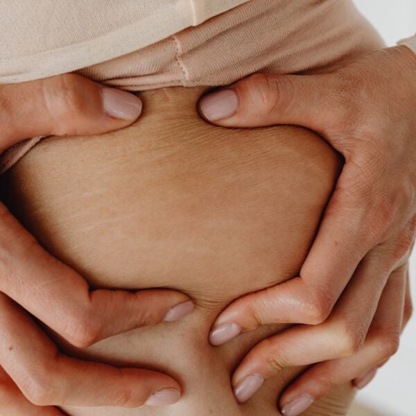 Genetic Predisposition for Stretch Marks