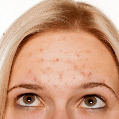 Is Acne Genetic