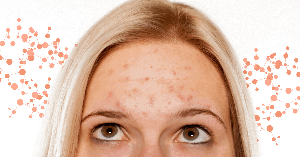 Is Acne Genetic