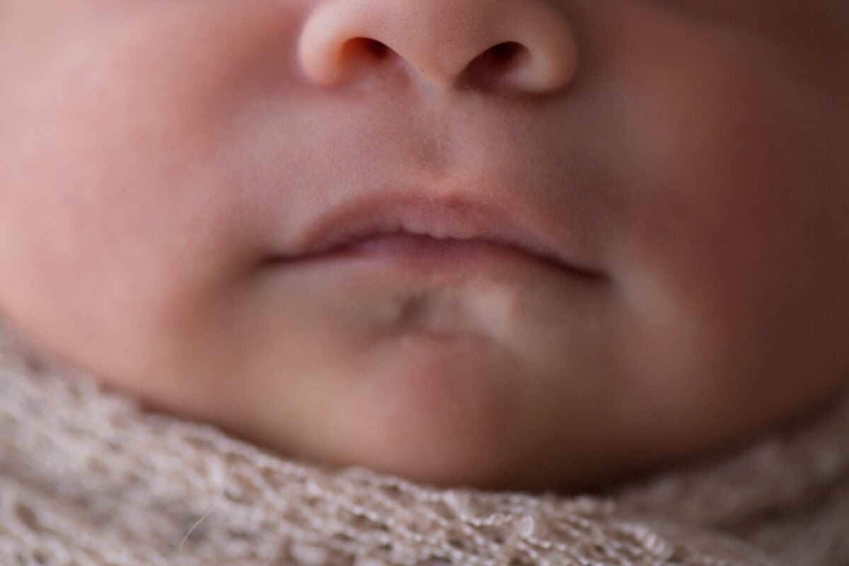 Are Cleft Chins Inherited? How Genes Affect Chin Shape and Wellness