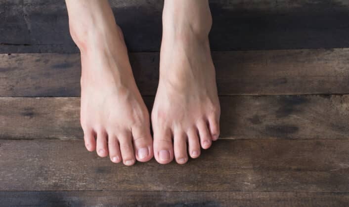 Flat feet condition, showing the foot arch, exploring the genetic link between heredity and flat feet.