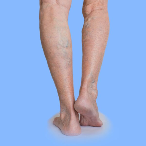 Are Varicose Veins Genetic?