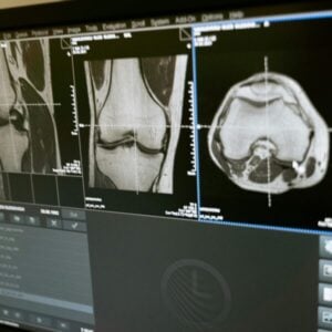 A Genetic Exploration of Bone Density and Fracture Risk