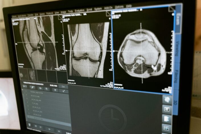 A Genetic Exploration of Bone Density and Fracture Risk