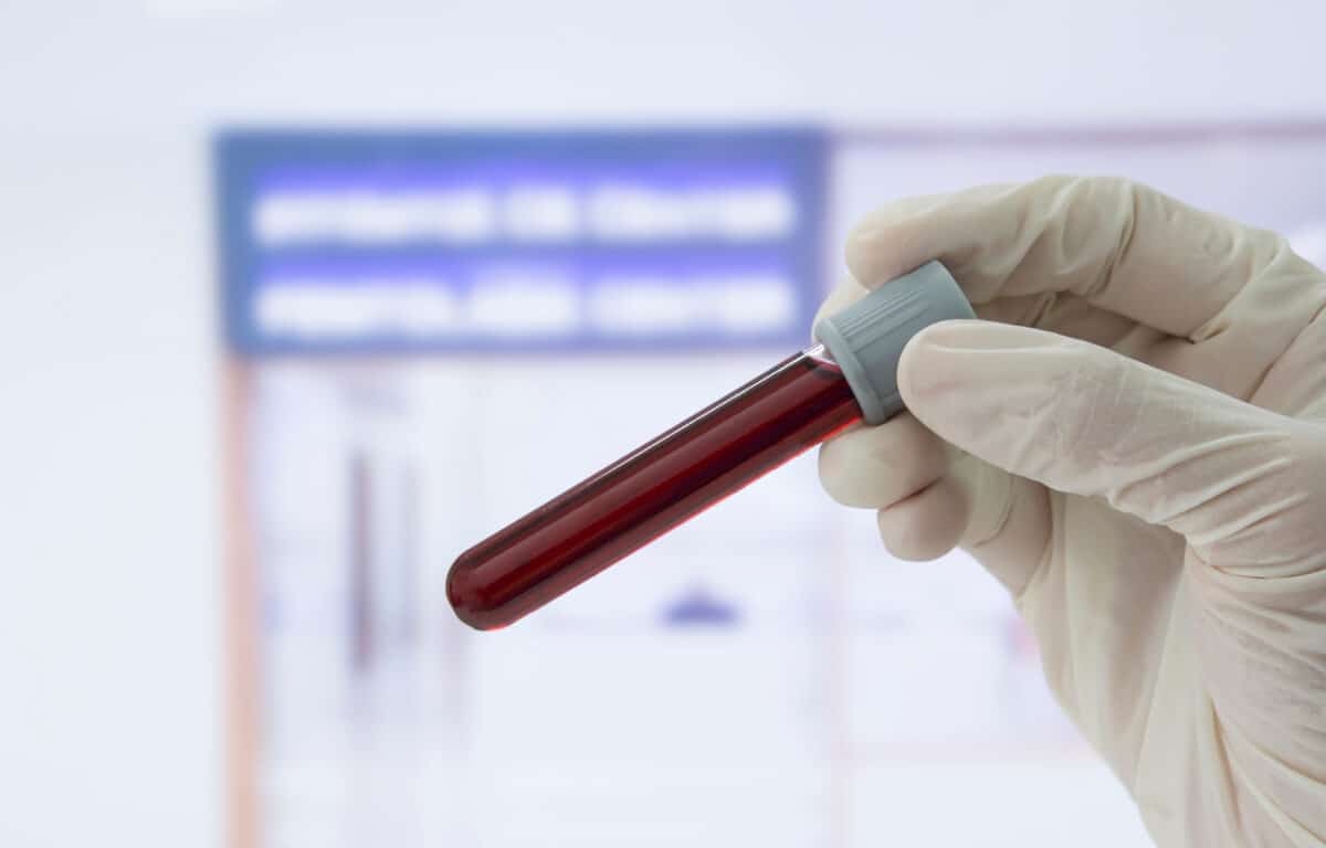 Hand holding a glass of blood, symbolizing the importance of understanding chloride levels in blood tests.