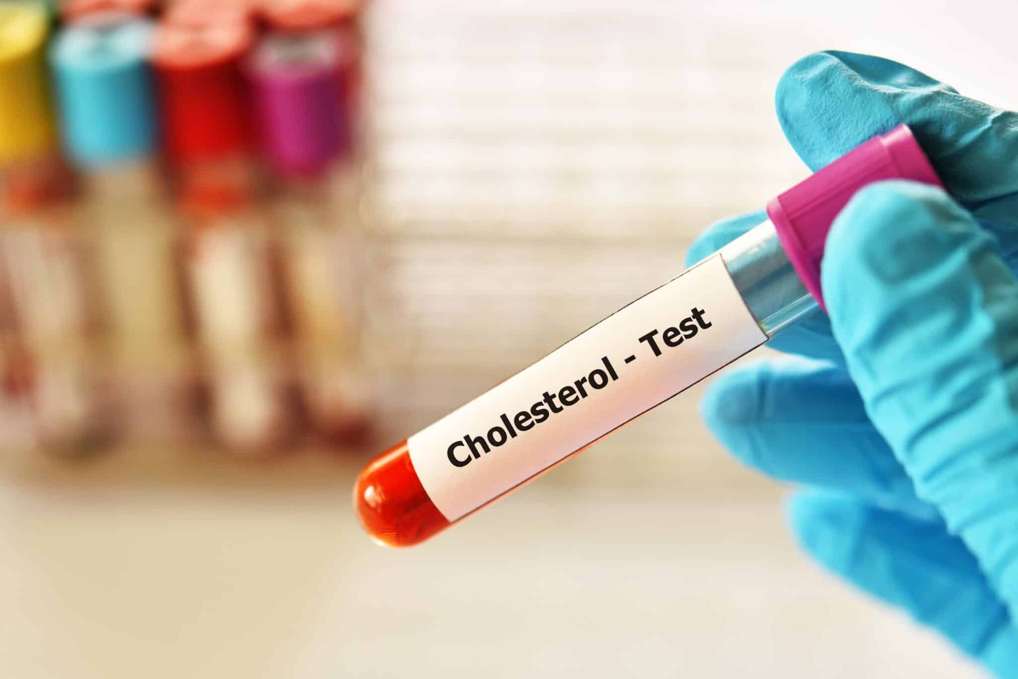 Image of a blood cholesterol test, used to help diagnose metabolic disorders like Niemann-Pick Disease.