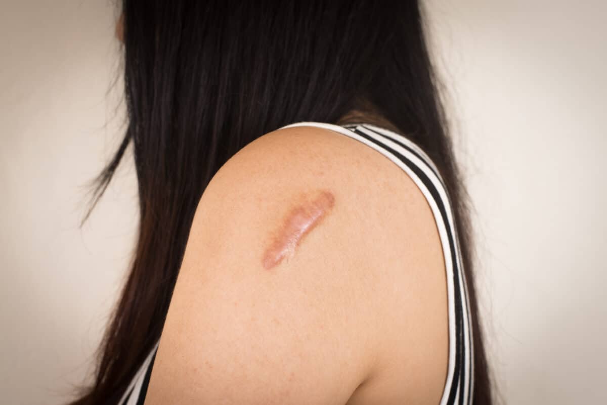 Image of a person with a raised keloid scar on the shoulder, showing the thickened and overgrown skin.
