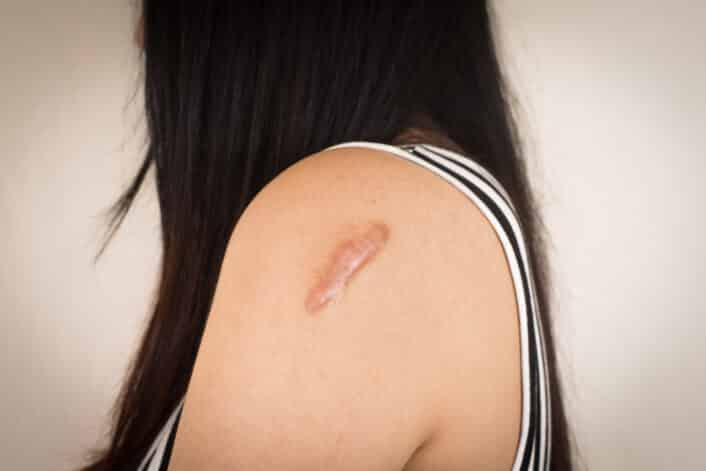 Image of a person with a raised keloid scar on the shoulder, showing the thickened and overgrown skin.