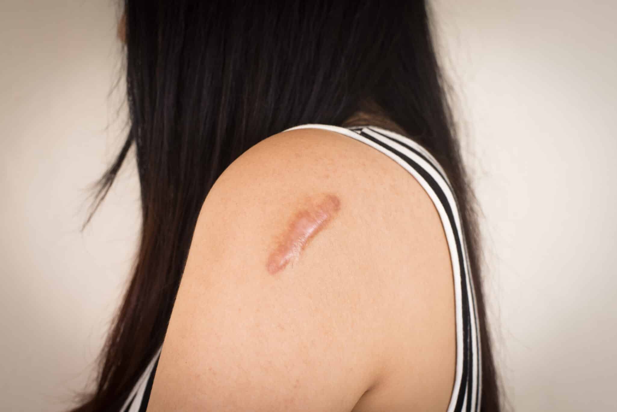 Image of a person with a raised keloid scar on the shoulder, showing the thickened and overgrown skin.