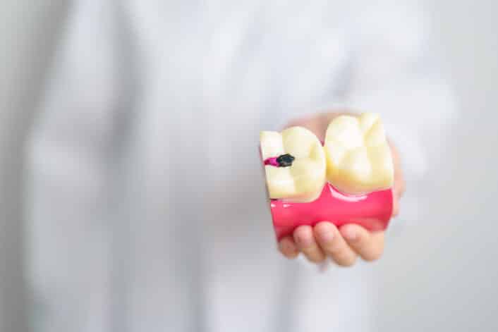 Close-up of teeth cavities, representing the genetic link to tooth decay.