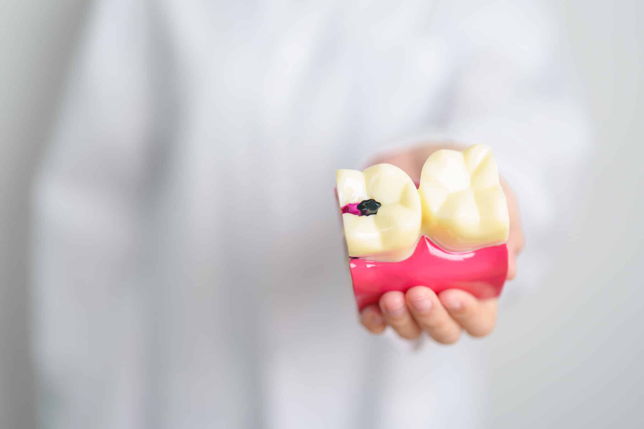 Close-up of teeth cavities, representing the genetic link to tooth decay.