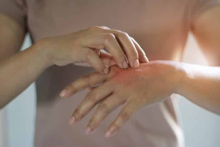 Person scratching itchy hand, representing symptoms of systemic sclerosis (scleroderma), an autoimmune disease possibly influenced by genetic factors.