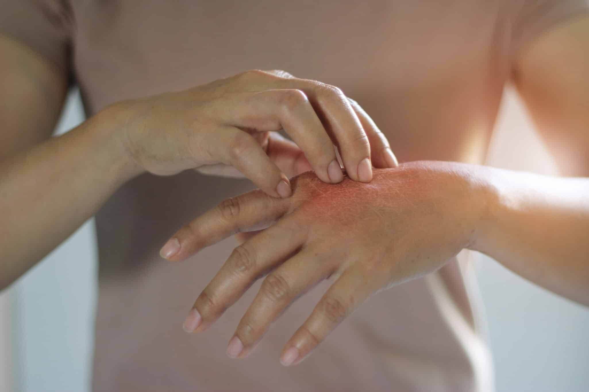Hand with redness representing inflammation or nerve symptoms related to multiple sclerosis
